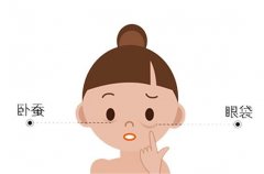 臥蠶手術(shù)需要多少錢呢，臥蠶和眼袋有什么區(qū)別