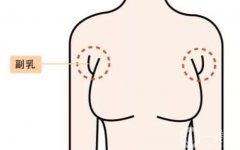 切除副乳后怎么護(hù)理？