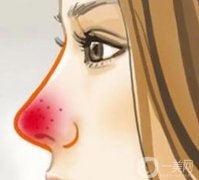 酒渣鼻的病因是什么?有哪些癥狀？