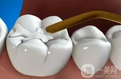 補牙是不是*性的？可以維持多久？