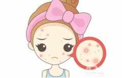 什么因素影響祛痘手術(shù)的價格？