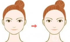 下頜角做截骨術(shù)要戴頭套的原因是什么？