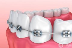 矯正牙齒有哪幾種類型？
