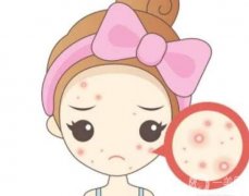 紅藍(lán)光祛痘會(huì)很疼嗎