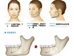 下頜角整形手術(shù)后有多長(zhǎng)的恢復(fù)期？