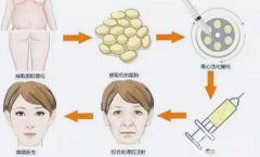 臥蠶可以填充自體脂肪嗎？