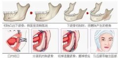 下頜角截骨術(shù)存在風(fēng)險(xiǎn)和后遺癥嗎？