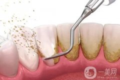 洗牙后牙齦出血怎么辦？洗完牙應(yīng)該怎么護(hù)理？