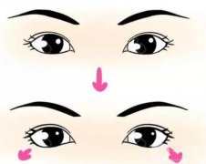 下眼瞼手術(shù)有哪些風(fēng)險(xiǎn)？