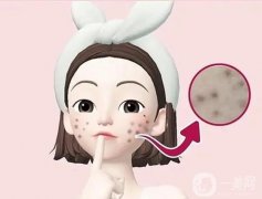 激光去痘印可能存在什么風(fēng)險?