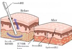 水動(dòng)力吸脂會(huì)留下疤痕嗎？水動(dòng)力吸脂術(shù)的優(yōu)點(diǎn)有哪些？