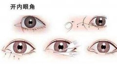 開內(nèi)眼角和外眼角的區(qū)別？