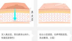 像素激光和點(diǎn)陣激光的不同之處是什么？