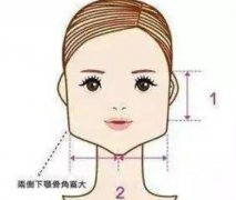 下頜角截骨術(shù)完全恢復(fù)需要多長(zhǎng)時(shí)間？