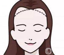 脫發(fā)際線產(chǎn)生的副作用如何避免？