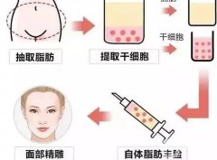 自體脂肪填充有什么優(yōu)勢？