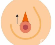 乳暈手術(shù)的特點是什么?需要注意哪些事項？