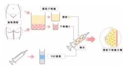 自體脂肪和脂肪膠的區(qū)別是什么？