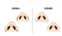 怎么避免鼻翼縮小的后遺癥？