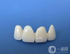 洗牙牙齒會松動嗎？怎么護理烤瓷牙？