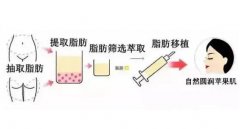 自體脂肪填充的缺點(diǎn)有哪些？