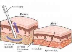 水動力吸脂后需要多長時間才能開始工作？