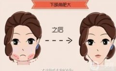 適合磨骨瘦臉的人群有哪些？