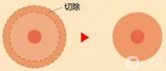乳暈縮小手術(shù)對身體影響大不大？