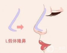 隆鼻假體取出后恢復(fù)需要多長時(shí)間？取出隆鼻假體的價(jià)格？
