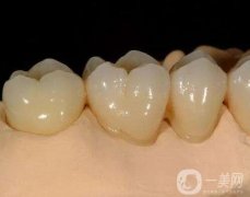 做烤瓷牙要多久？烤瓷牙有哪些種類？