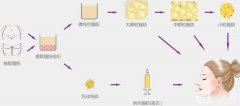 自體脂肪填充有什么風險？