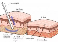 水動力吸脂是*性的嗎？可以持續(xù)多久？