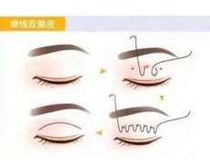 雙眼皮失敗的癥狀有哪些？