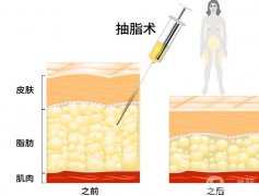 能在抽脂之后立即走路嗎？