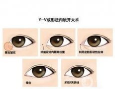 開眼角的疤痕怎么才能快速消失？開眼角疤痕多久能消除？