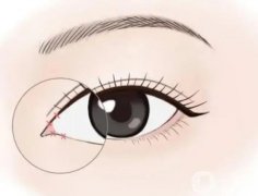 什么方法開(kāi)眼角果好?開(kāi)眼角好嗎?