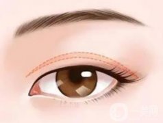 導(dǎo)致雙眼皮疤痕增生的原因是什么