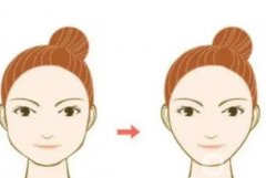 磨骨會出現(xiàn)下垂的情況嗎？