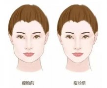 激光溶脂瘦臉有什么副作用？