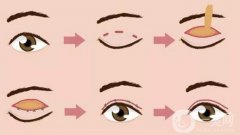 做雙眼皮需要多長(zhǎng)時(shí)間才能恢復(fù)？
