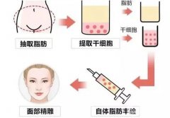自體脂肪過度的填充應(yīng)該怎么補(bǔ)救？