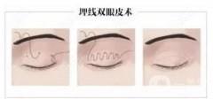 雙眼皮埋線有哪些注意事項(xiàng)？