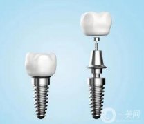 種植牙用的材料有哪些？