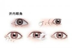 開眼角有可能回縮嗎？開眼角大概要多少錢