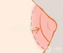 乳暈縮小術(shù)有幾種方法？