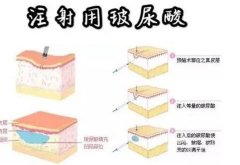 玻尿酸是什么？注射多少次可以定型？