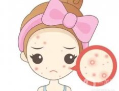 激光去痘痘要多少錢？