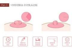 乳頭縮小是否影響母乳喂養(yǎng)，乳頭縮小手術(shù)有什么特點(diǎn)？
