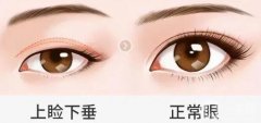 矯正上瞼下垂的怎么樣，有哪些后遺癥？