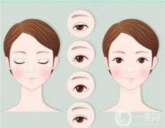 怎么把單眼皮變成雙眼皮？